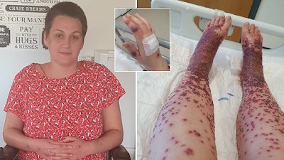 See Body Reaction Woman Got After COVID-19 Vaccine Jab